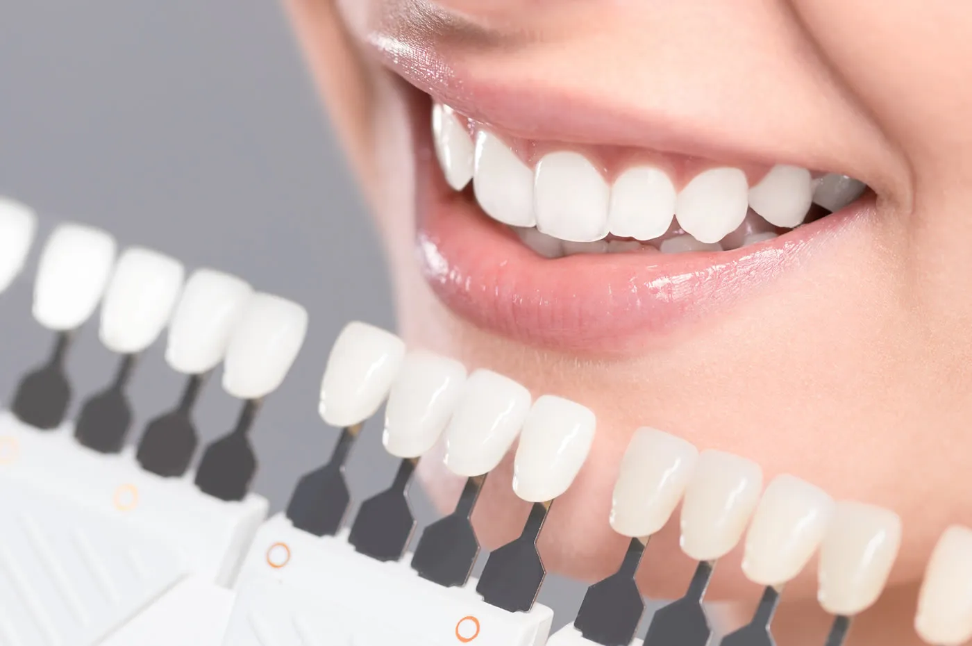 A smile next to a porcelain shade guide